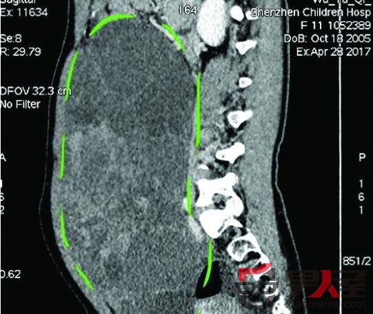 CT ͼ